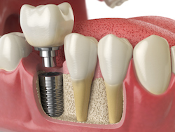 dental implants tooth replacement